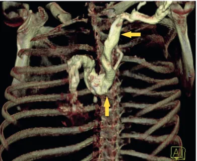 Figure 3. Volume rendered 3D image of the aberrant LBV (yellow arrow), anterior view. 