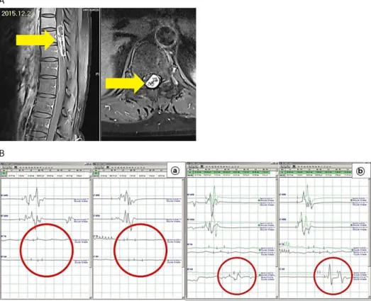 Fig.  1.  (A)  MRI  of  spine  body  fracture  L12-T1.  (B)  Motor  evoked  potentials  wave  forms