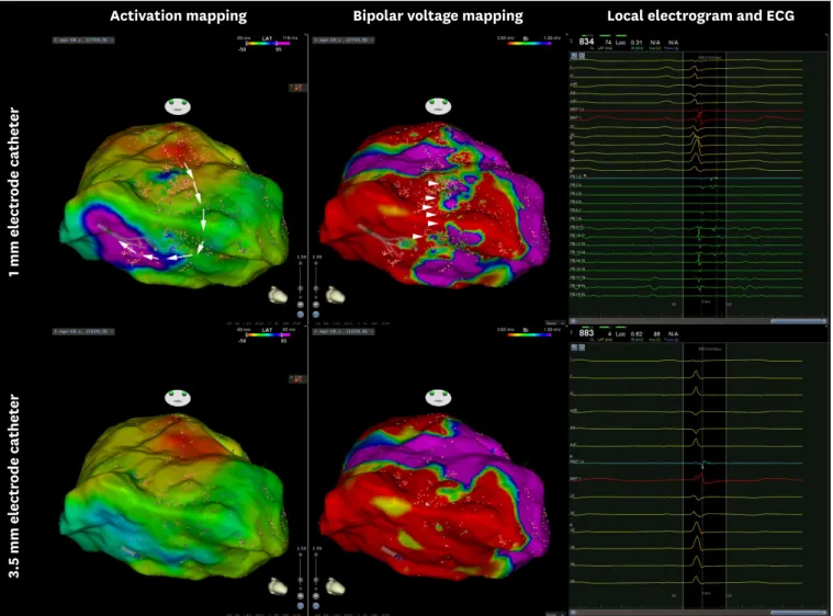 Figure 1. Example of differences in the bipolar voltage map created using the 1-mm electrode catheter and 3.5-mm electrode catheter in the patient with  ARVD/C