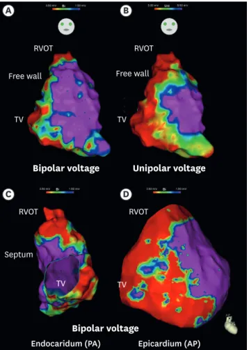 Figure 2. 3D electro-anatomic characteristics in the patients with ARVD/C. Example of substrate mapping in a  patient with definite ARVD/C