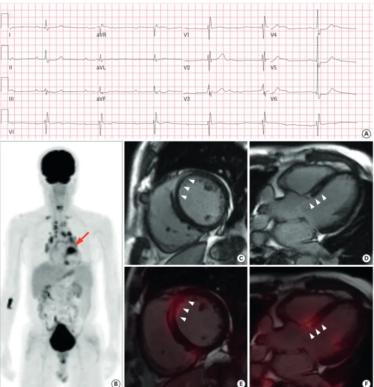 Figure 1. (A) Electrocardiogram; PET/MRI. (B) A whole-body image of the FDG uptake. T1-weighted image; (C) short-axis and (D) long-axis, and cardiac PET/MRI  image; (E) short-axis and (F) long-axis