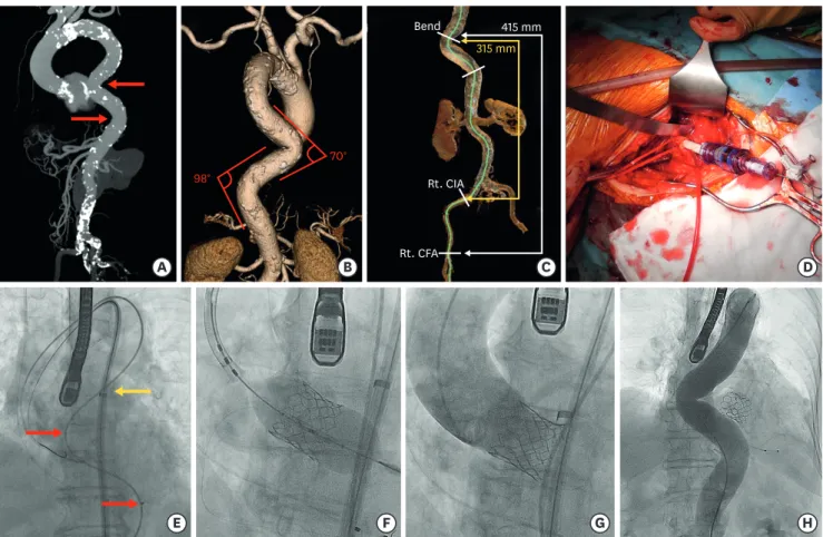 Figure 1. (A-C) Pre-procedural MDCT (A) Left anterior oblique view of maximum intensity projection showing a markedly tortuous thoracic aorta and no  significant calcification around the acute bend (red arrows)