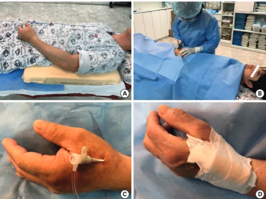 Figure 1. Patient's position for the left snuffbox approach (A) and operator on the right side of the patient  preparing left snuffbox approach (B)