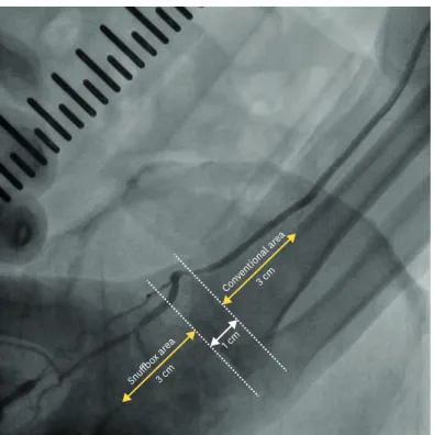 Figure 2. Angiography of the left radial artery to investigate the maximal diameter of snuffbox and conventional  radial artery.