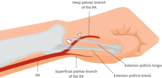 Figure 1. The pathway of RA via anatomical snuffbox and left hand posture of patient for puncture