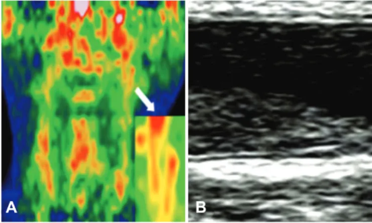 Fig. 4. Example of the image from integrated PET/CT device at transverse  image and carotid ultrasonography