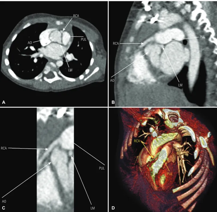 Fig. 1. Preoperative diagnostic images of the anomalous right coronary artery. (A) Computed tomographic angiography showing the anomalous right  coronary artery originating from the pulmonary artery in coronal view, (B) sagittal view, (C) zoomed view, and 