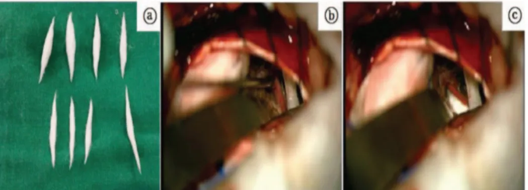 Fig.  3.  Teflon-felt  is  insert  between  the  facial  nerve  and  blood  vessel  (a)