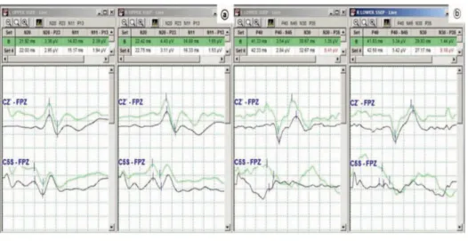 Fig.  4.  SSEP  2ch  Upper  Cz’  cortial  potentials  (N20),  C5s  subcortical   po-tentials (N11) (a) and Lower Cz’ cortical  potentials  (P40),  C5s  subcortical   po-tentials  (N30)  (b).