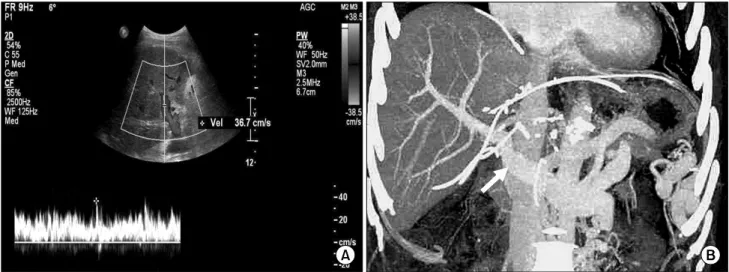 Fig.  3.  Imaging  studies  after  LDLT.  (A)  Postoperative  Doppler  ultrasonography  shows  satisfactory  portal  blood  flow  in  the  liver graft