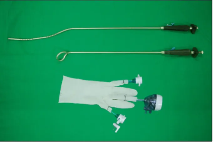 Fig.  4.  Operative  illustration  using  two-port  laparoscopic  cholecystectomy.  Note  that  two  laparoscopic  instruments  respectively  gripped  by  operator’s  both  hands  pose  a  stable  angle  ranged  40∼70 o .