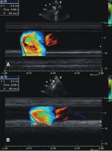 Fig. 1. Measurement of APV in a subject in the control group (A) and in a  patient with FMF (B)