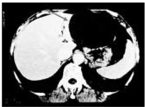 Fig. 2. Caroli s disease