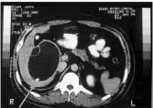 Fig. 3. Hydatid cyst (c) Gross Finding