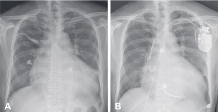 Fig. 1. Electrocardiographic findings before and after initiation of cardiac  resynchronization therapy