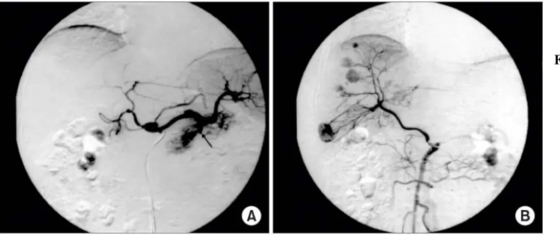 Fig.  2.  Contrast  enhanced  abdominal  CT  scan  demonstrating  6×4  cm  sized  hypervascular  mass  of  pancreas  tail  in  lobulating  contour.