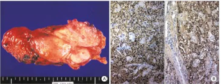 Table  1.  Tumor-specific  risk  factor:  size,  histomorphology,  meta- meta-stses