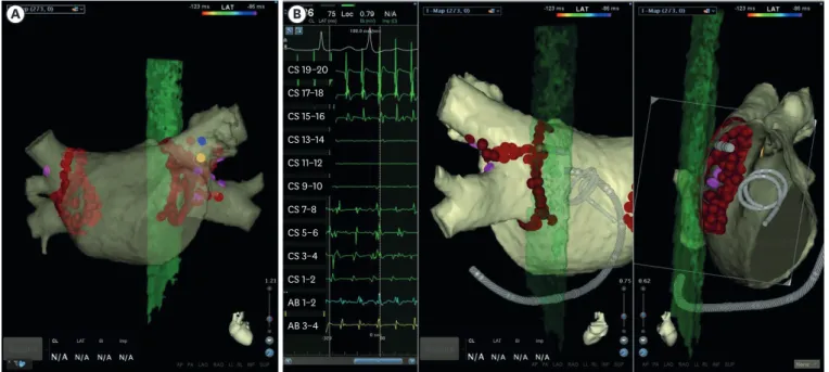 Figure 1. Radiofrequency ablation findings. (A, B) Electroanatomic mapping images of the left atrium acquired by the CARTO 3 Navigation System show that  linear ablation at the posterior wall was performed in front of the esophagus during left-side antral 