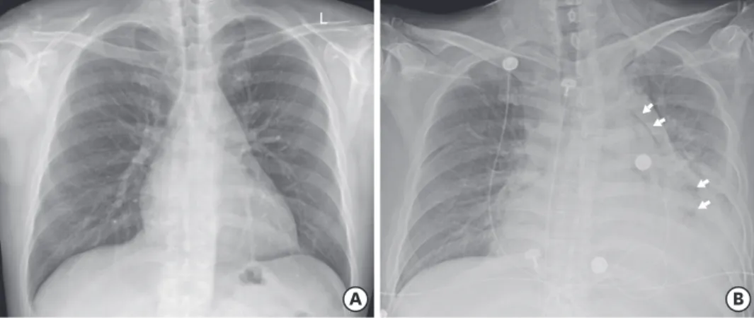 Figure 4. Chest CT scan findings. (A) An initial chest CT image shows clusters of small air bubbles (black arrow)  in the pericardial space, which is highly suggestive of an esophageal perforation