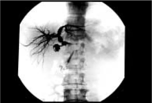Fig. 2. Balloon dilatation of the bile duct stricture
