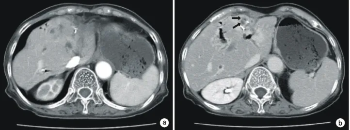 Fig.  3.  (a,  b)  A  46-year-old  womam:  magnetic  resonance  (MR)  imaging  scans  taken  8  months  after  the  left  lateral  sectionectomy  show  left  intrahepatic  duct  stones  and  intrahepatic  abscess  formation  in  B4.