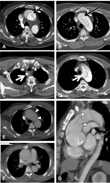 Fig. 2. Distinct intimal flap defect found in the ascending aorta (A), the  anterosuperior arch (B), and origin of aberrant right subclavian artery (C  and D)