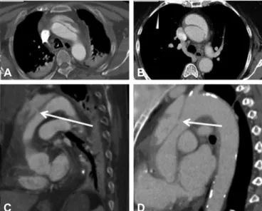 Table 2. Accuracy of predicting intimal tear site with computed tomography findings