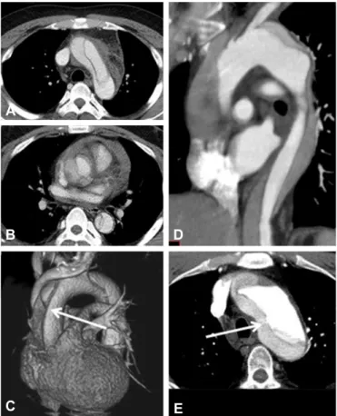 Fig. 5. The cases of retrograde dissection from descending aortic tear for  which all radiologists were inaccurate