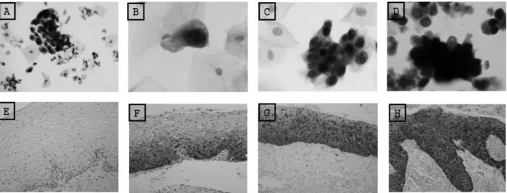 Fig.  1.  Results  of  p16 INK4a /Ki-67  dual  immunostaining  for  liquid-based  cytology  (A,  B,  C,  D)  and  tissue  (E,  F,  G,  H)