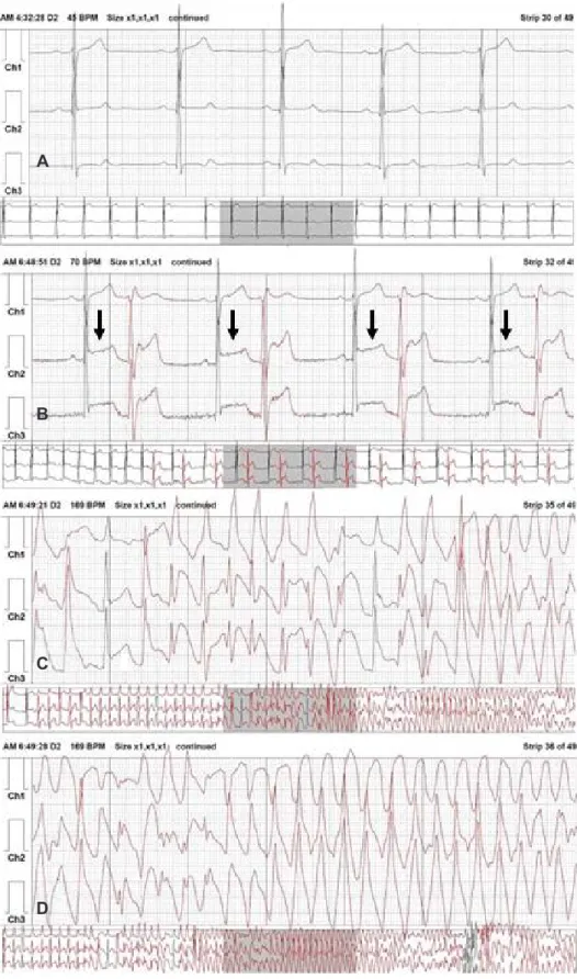 Fig. 2. Channels 1, 2, and 3 of Holter electrocardiogram (ECG) are regarded as lead V1, V6, and II of the 12 lead  ECG, respectively