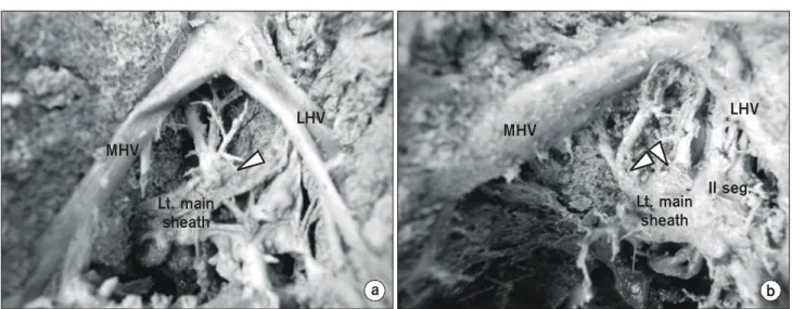 Fig.  3.  (a)  (Case  9)  Photograph  of  dissected  specimen.  It  shows  the  additional  pedicle  of  segment  IVa  from  left  main  Glissonian  sheath  (arrow  head  =  additional  pedicle  of  segment  IVa;  MHV  =  middle  hepatic  vein)
