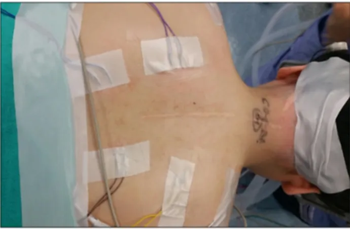 Figure  10.  Electrodes  attached  to  the  back  muscle  to  observe  accessory  nerve  (ICN  XI).