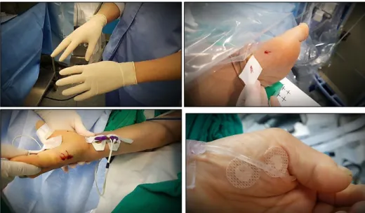 Figure  12.  Make  sure  to  wear  gloves  and  attach  a  blood  control  band  after  removing  the  electrodes.