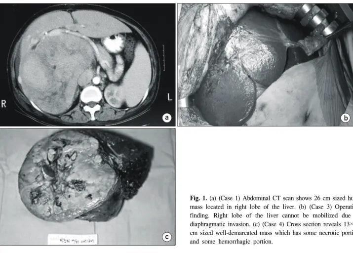 Fig.  2.  (Case  5)  (a)  Pre-enhanced  abdominal  CT  scan  shows  15×13  cm  sized  huge  mass  which  contains  lipiodol  from  previous  TACE  (transcatheter  arterial  chemoembolization)