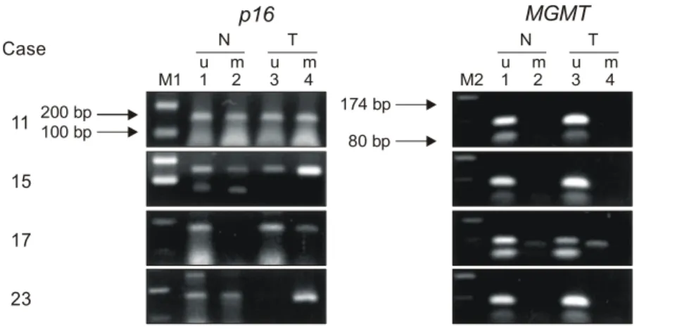 Table  4.  Methylation  status  and  expression  of  p16  and  MGMT  in  hepatocellular  carcinoma  tissues