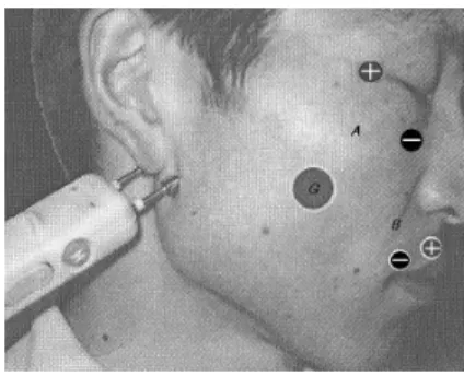Fig.  1.  Position  of  electrodes이런 여러 원인에 의해 안면신경의 수초에 대한 자가 면역 반응과 염증 세포의 침윤 및 그에 따른 부종으로 탈수초 현상이 일어나서 신경 전도에 이상이 오는 것이 병인으로 추정된다(Hyden  등, 1982; Roob 등, 1999)