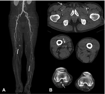Fig. 3. Baseline angiography before endovascular treatment showed no  visualized distal vessel to access