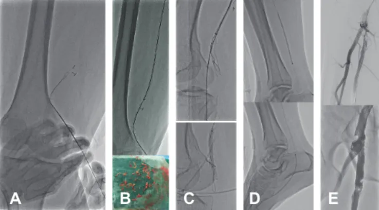 Fig. 4. Step-by-step procedure scheme. (A) Direct retrograde puncture of  the previous popliteal stent and advance of the 0.035-inch guide wire
