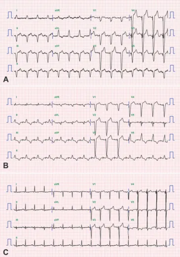 Fig. 1. Radiographic changes of the patient before and after normal QRS  axis pacing. (A) Initial chest X-ray at admission shows implanted  pacemaker with marked cardiomegaly