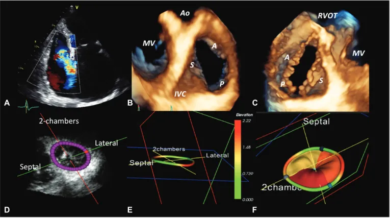 Fig. 2. Comprehensive assessment of the anatomy of functional tricuspid regurgitation by transthoracic three-dimensional echocardiography