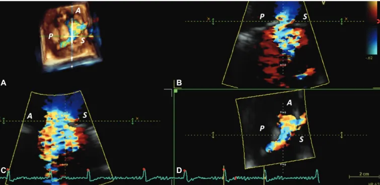Fig. 5. Challenges in assessing the tricuspid regurgitation (TR) severity by two-dimensional-Doppler Proximal Isovelocity Surface Area method in a patient  with severe functional TR in atrial fibrillation