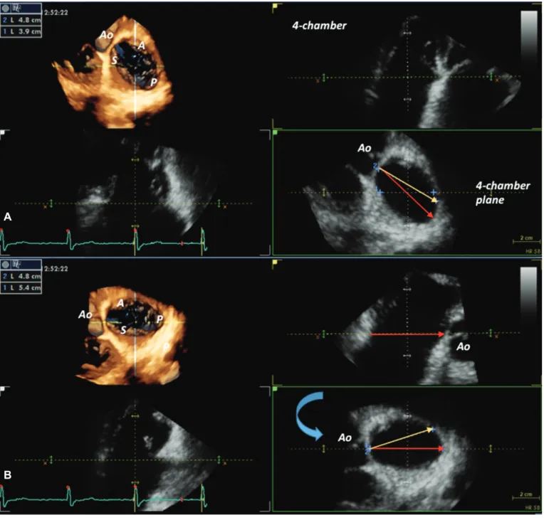 Fig. 6. Impact of various methods of tricuspid annulus diameter sizing, demonstrated by three-dimensional echocardiography