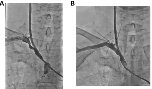 Figure  3.  Duplex  sonography  in  left  carotid  arteries.  (A)  Left  common  carotid  artery,  (B)  Left  internal  carotid  artery,  (C)  Left  external  carotid  artery,  (D)  Left  vertebral  artery