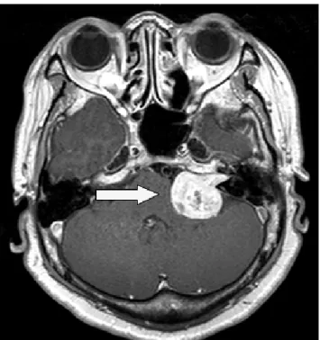 Fig.  1.  MRI  of  vestibular  schwannoma.