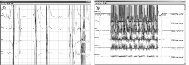 Fig.  4.  Artifact  of  Electrocautery  (ⓐ  bipolar  stimulation,  ⓑ  monopolar  stimulation).