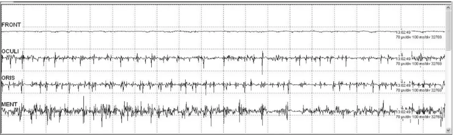 Fig.  6.  Electromyography  of  self  activity. 첫째, 환자의 호흡곡선에 자발호흡의 조짐이 관찰된다. 둘째, 혈 압이 서서히 오른다