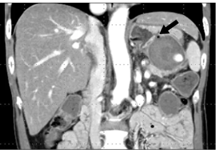 Fig.  1.  There  was  shown  a  typical  finding  of  chronic  pan- pan-creatitis  with  duct  dilatation  and  multiple  calcifications