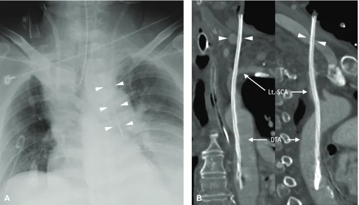 Fig. 1. Chest X-ray and three-dimensional computed tomography angiography. (A) Chest X-ray showing the misplaced catheter tip in the descending  thoracic aorta (DTA, white arrowhead)