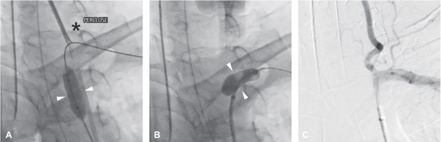 Fig. 3. Endovascular repair using suture-mediated closure devices and a temporary balloon tamponade