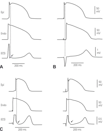Fig. 1. The sequence of ventricular activation influences the appearance of  J wave in a transmural ECG recorded from coronary-perfused canine left  ventricular wedge preparation